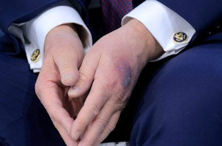 White House explains bruise on Trump’s hand